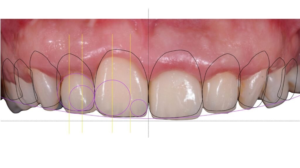 A close-up of upper front teeth with digital outlines and guides superimposed, showing tooth shapes, positions, and alignment for dental analysis or cosmetic planning. The gums are visible above the teeth.